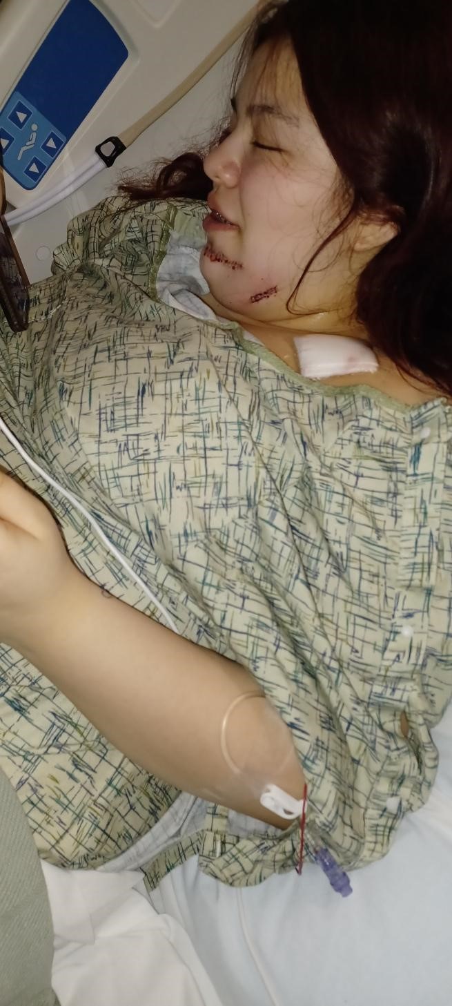 An adolescent girl lies in a hospital bed with wounds on her face.